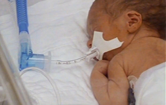 Preterm Infant